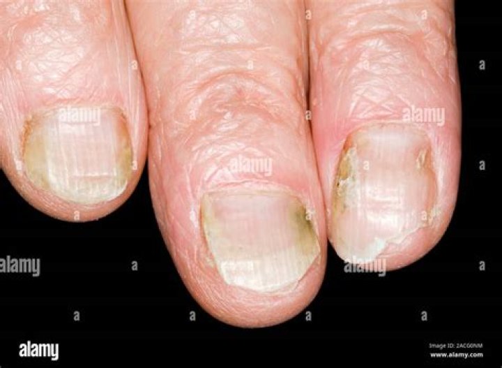 3,146 Onychomycosis Images, Stock Photos & Vectors Shutterstock