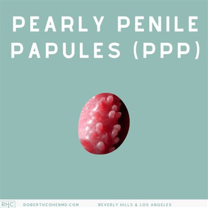 Do Pearly Penile Papules Go Away