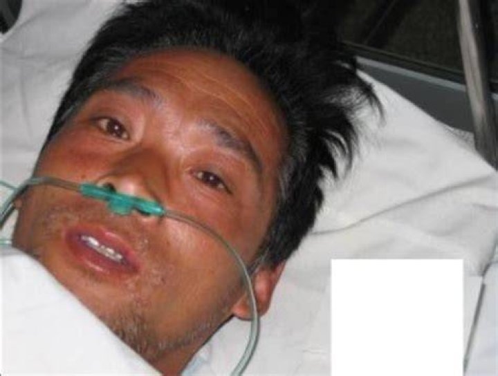 A picture of Hisashi Ouchi taken shortly after he was exposed to 17 Sv