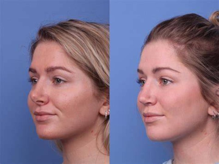 Amy Robach Plastic Surgery Before and After. Facelift, Body