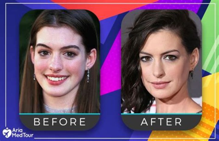 Anne Hathaway Plastic Surgery Nose Job, Lip Injections, Facelift