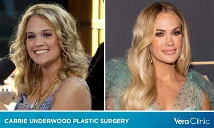 Are Carrie Underwood Plastic Surgery Rumors True? The Country Music