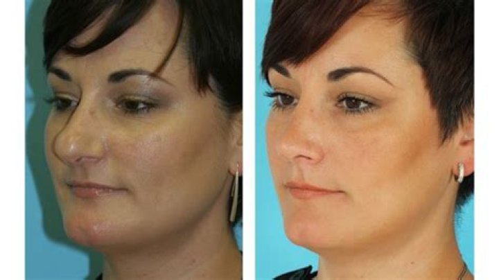 Before and After Brachio Plasty Photo Gallery Brent Moelleken M.D.