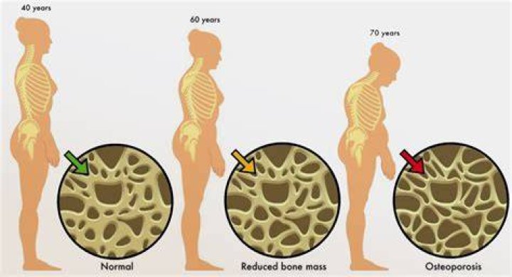 bone loss