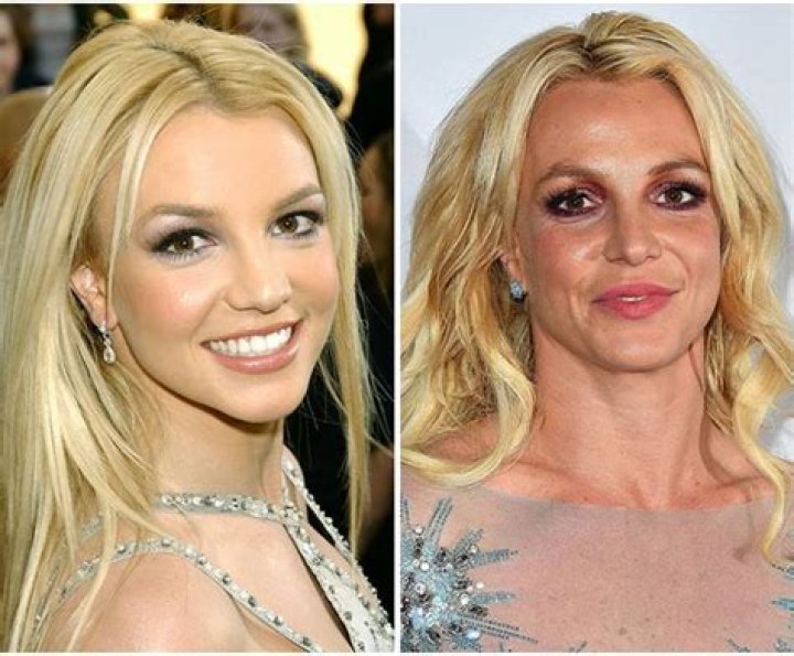 Britney Spears Before and After Cosmetic Surgery Verge Campus