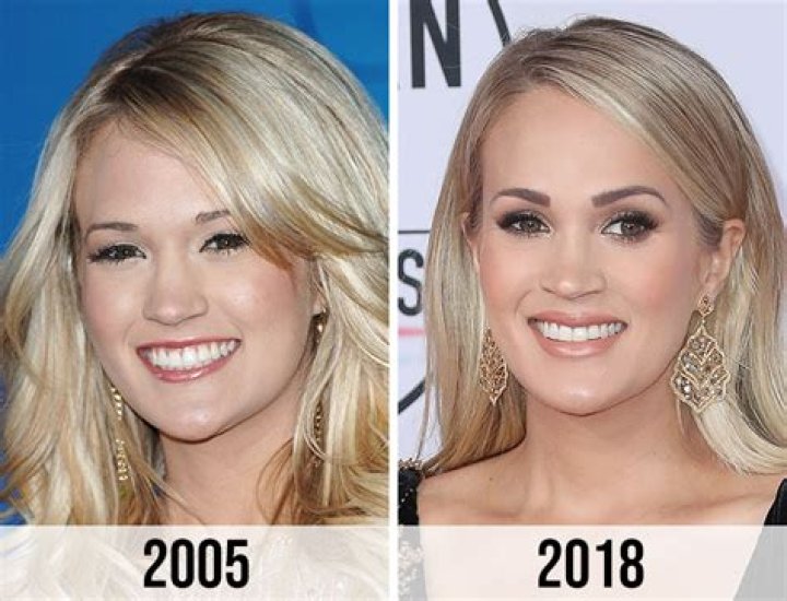 Carrie Underwood Plastic Surgery With Before And After Photos