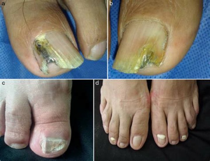 Clinical forms of onychomycosis. (a) Lateral subungual onychomycosis... Download Scientific Diagram