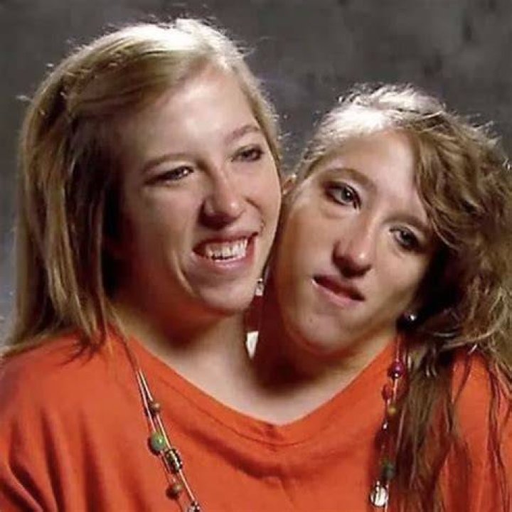 Conjoined twins abby and brittany hensel married bermoimg