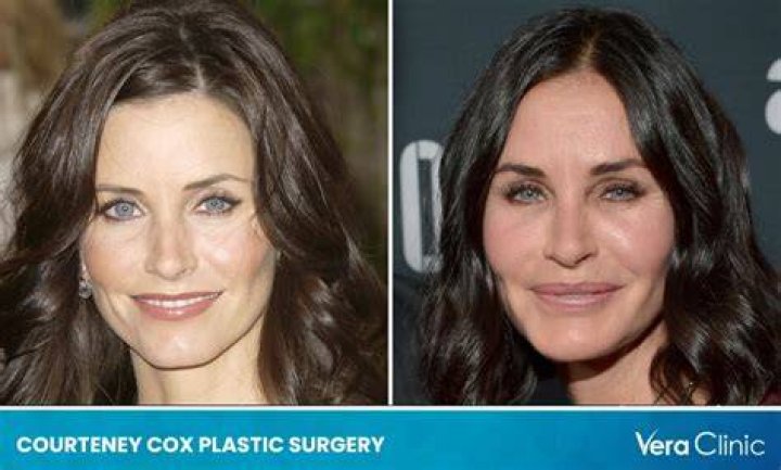 Courteney Cox Plastic Surgery With Before And After Photos