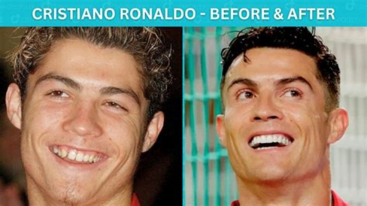 Cristiano Ronaldo teeth before and after, a selection of photos