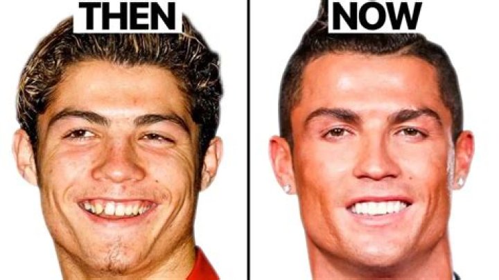 Cristiano Ronaldo Teeth Evolution Over The Years