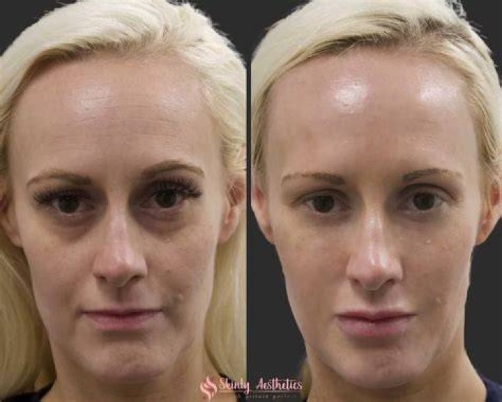De-clip before and after