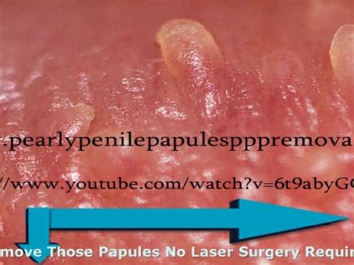 do pearly penile papules go away with age?