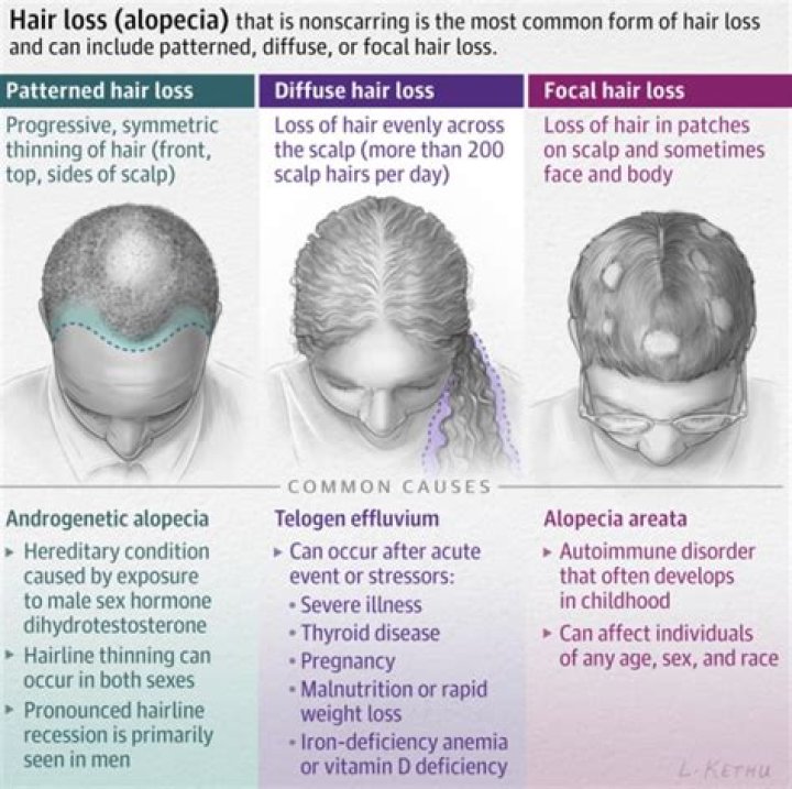 Does Matt Lucas have hair loss?
