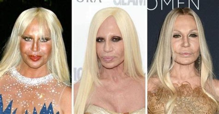 Donatella Versace Before Plastic Surgery And After