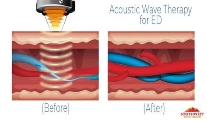 Erectile Dysfunction Acoustic Wave ...contemporaryhealthcenter.com