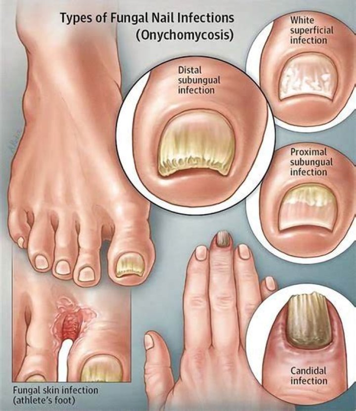Fungal Nail Infections Fungal Diseases CDC