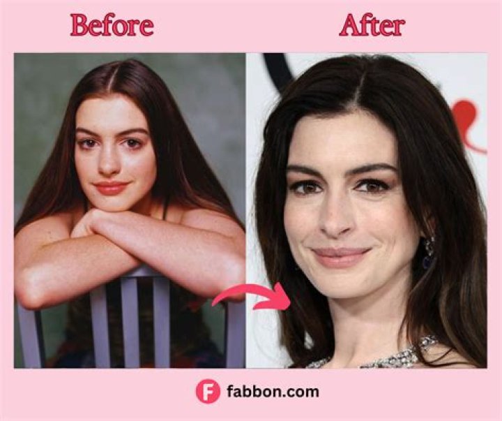 Has Anne Hathaway Undergone Plastic Surgery? See Her Transformation