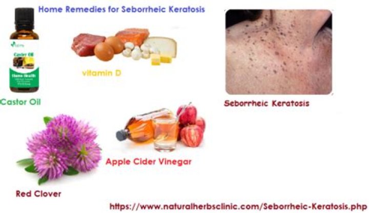 Home Remedies For Seborrheic Keratosis