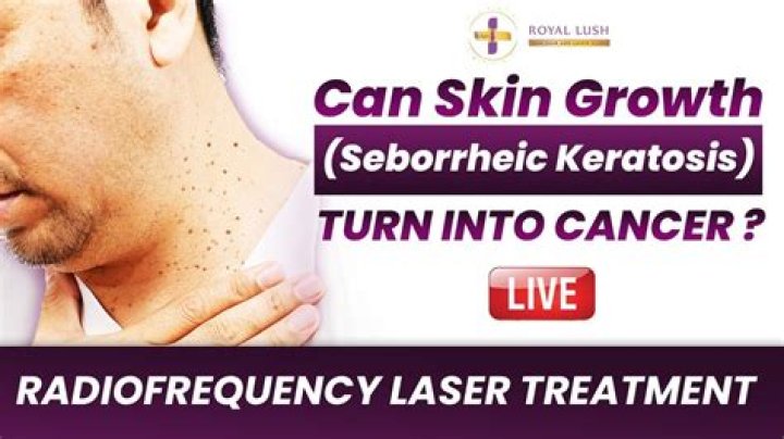 How To Remove Seborrheic Keratosis At Home Escons
