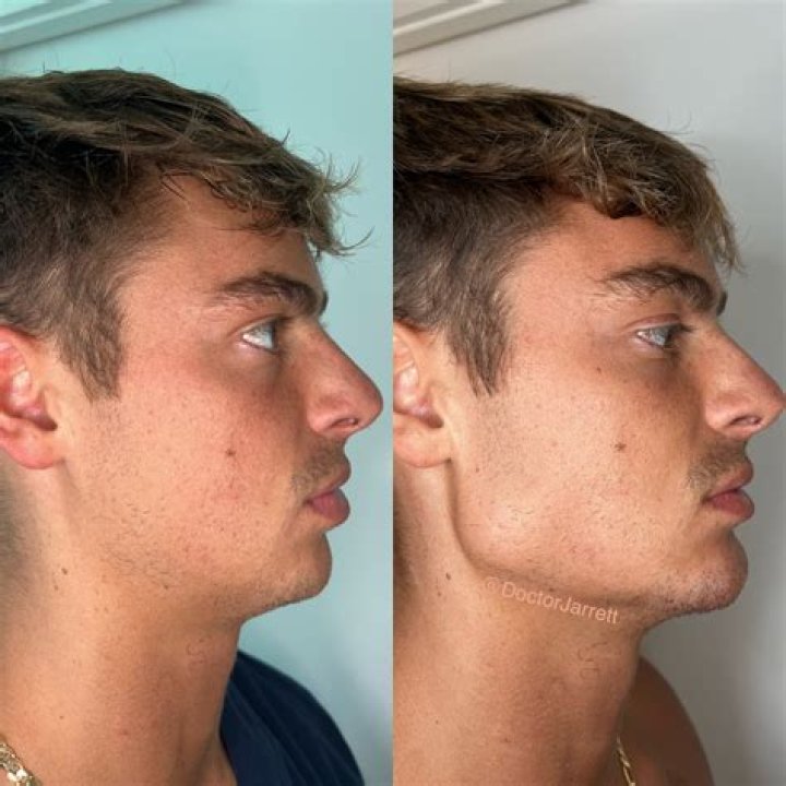 Jeff Lewis Shares Before & After Photos of His Face Following Cosmetic
