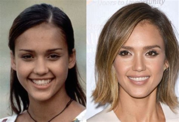 Jessica Alba before and after plastic surgery 45 Celebrity plastic