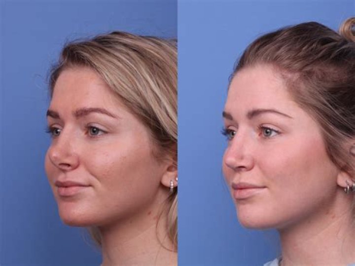 Johanna Leia Plastic Surgery Before And After Photos