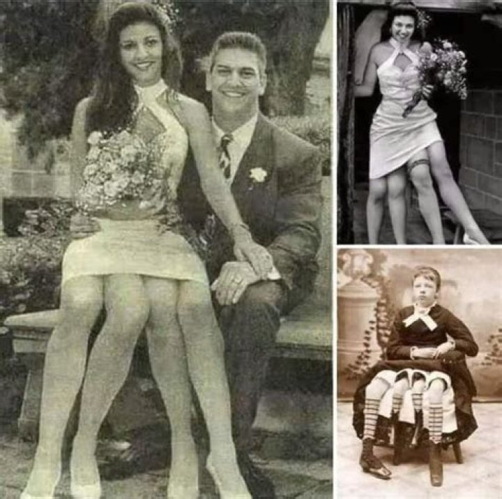 Josephine Myrtle Corbin, "the 4legged woman" her story, facts, and