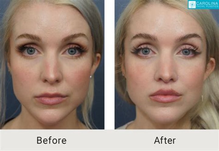 Julia Tica’s Plastic Surgery: The Internet Star Has Been Accused of Receiving Breast Implants, a Nose Job, Lip Fillers, and Chin Augmentation!