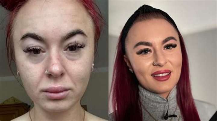 Lai Austria Real Gender: Before And After Surgery
