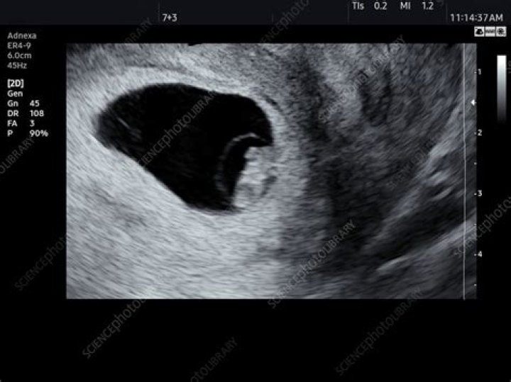 Lana Rhoades is 7 weeks and 5 days into her pregna... Lana Rhoades Shotoe