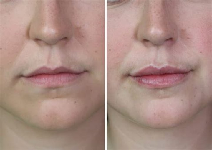 Lip Augmentation, Gscfour