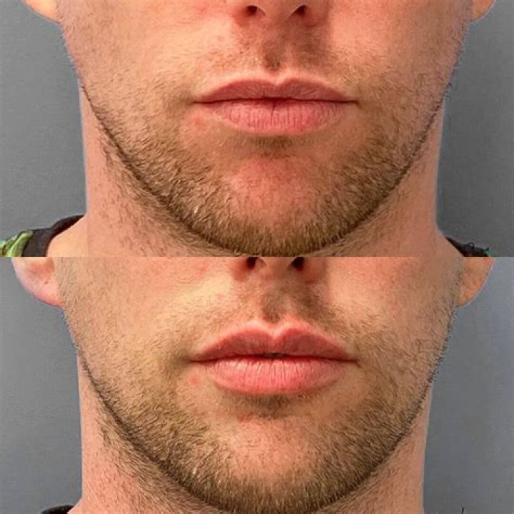 Lip Augmentation, Gscthree