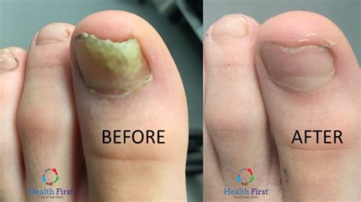 Lunula Laser nail fungus treatment before and after 1