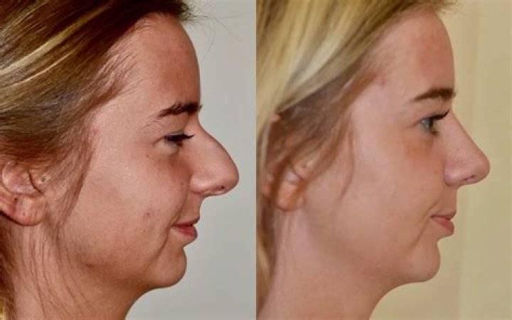 Lydia McLaughlin Before Plastic Surgery Body Measurements, Botox