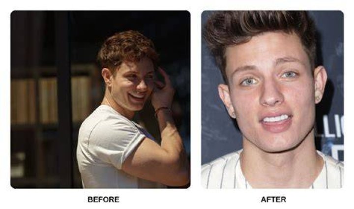 Matt Rife Teeth Before and After Venners Photos Are Adorable