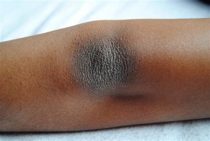No More Dark Ashy Knees and Elbows!