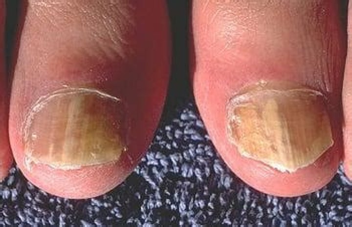 Onychomycosis - Dermatologic Disorders - Merck Manuals Professional Edition