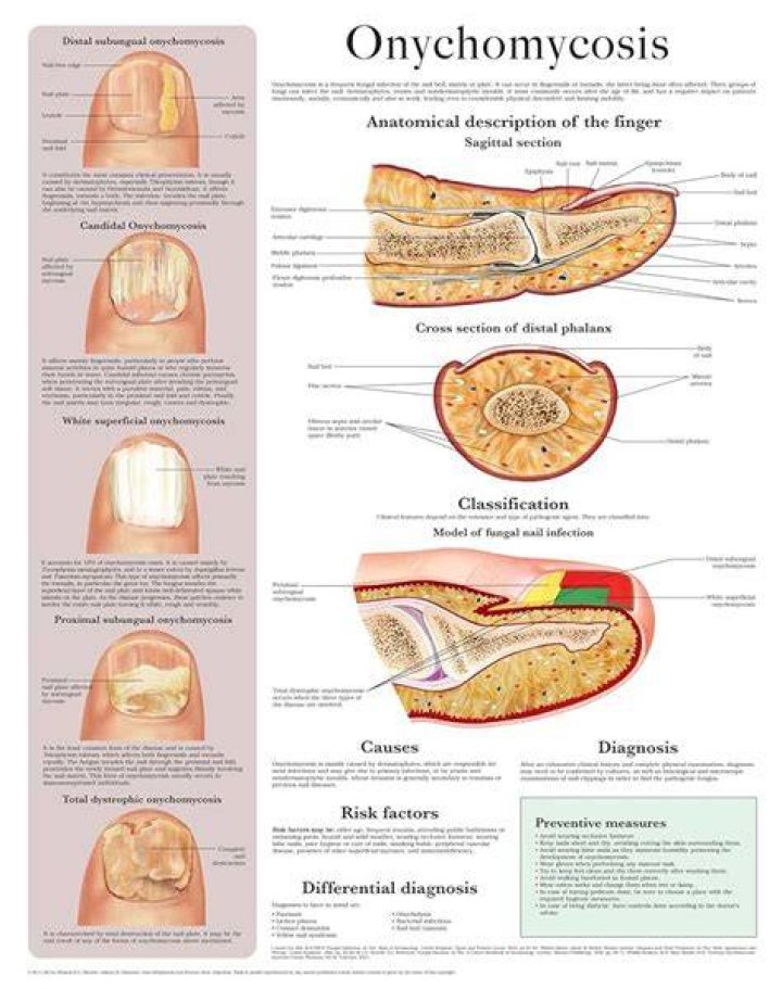 Onychomycosis - Dermatology - Medbullets Step 1