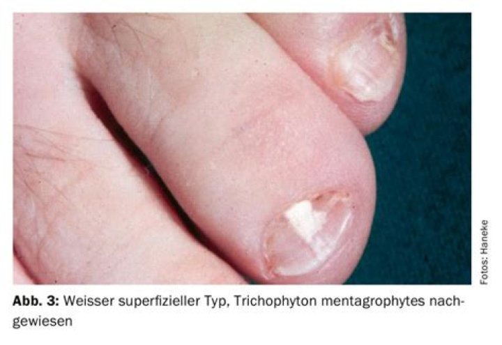 Onychomycosis - Journal of the American Academy of Dermatology