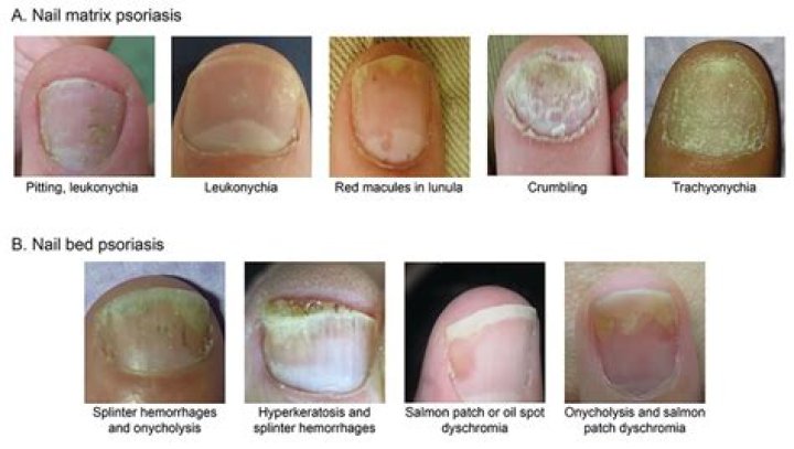 Onychomycosis Causes