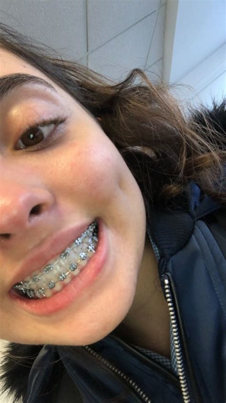 Pin on Cute Braces