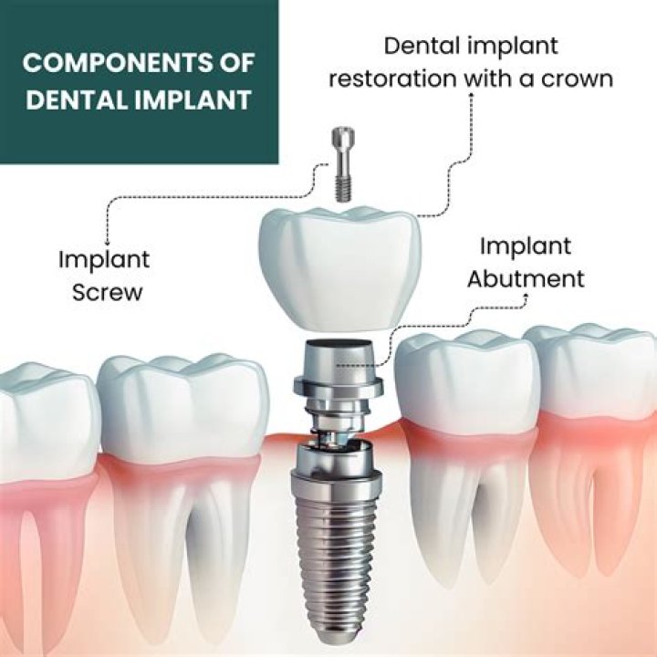 Pin on Dental Implants Full
