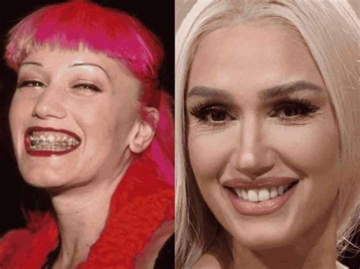 Rex Ryan Teeth Transformation Reality Revealed Before And After Rex