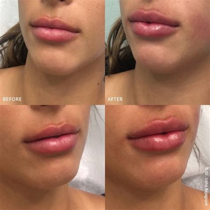 Sabrina Carpenter's Lip Filler Journey: Exploring The Transformation
