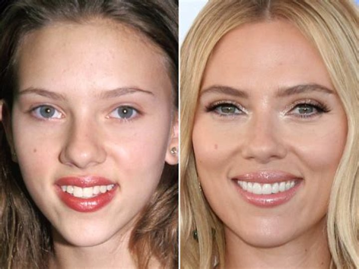 Scarlett Johansson Plastic Surgery Before and After Photos Follow News