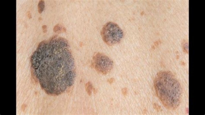 seborrheic keratosis removal, beautyteck YouTube