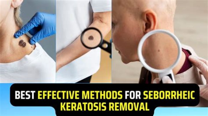 Seborrheic Keratosis Removal YouTube
