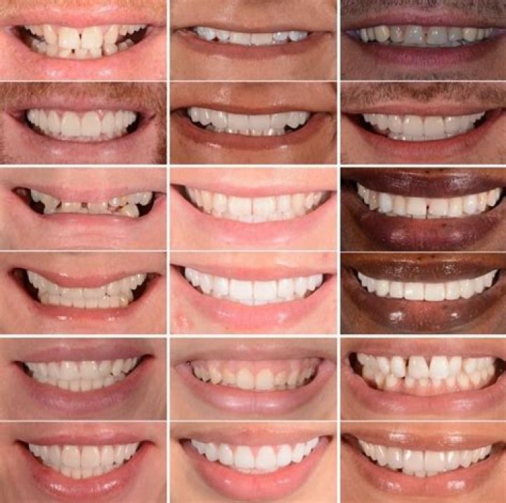 Smile Makeover, Gscseven