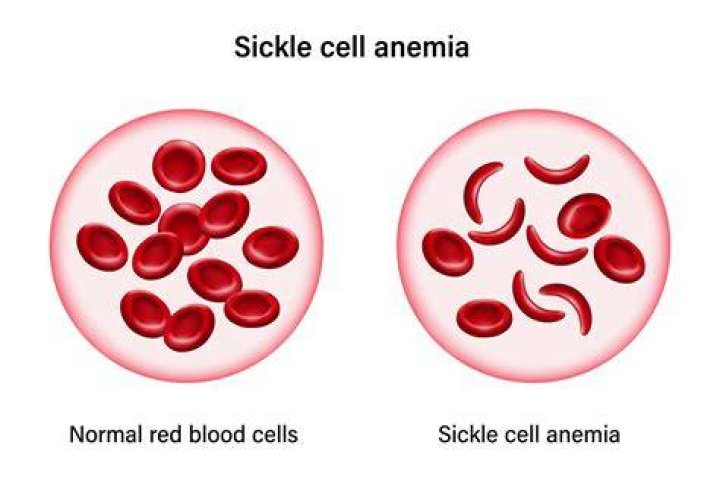 Tish Merrick Sickle Cell Anemia Battle During Pregnancy